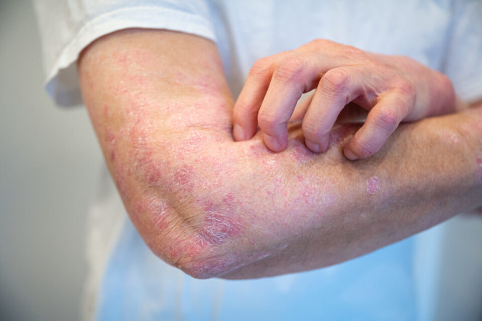 Psoriasis : une découverte majeure en France ouvre la voie au premier traitement véritablement sur mesure