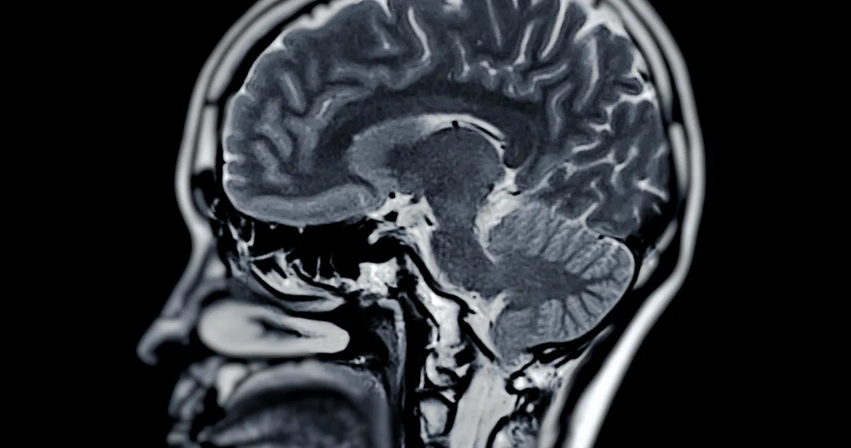 Des chercheurs japonais identifient un germe possiblement à l’origine de la maladie d’Alzheimer
