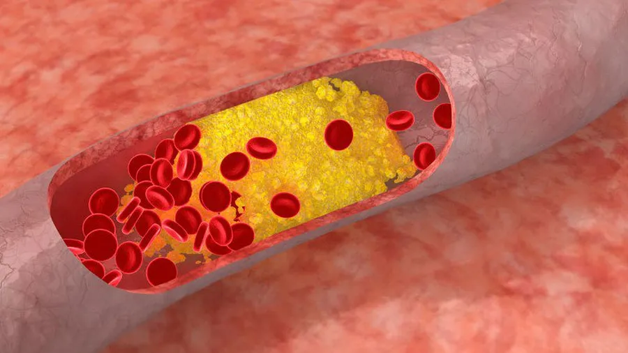 Cholestérol : trois nouveaux traitements attendus d’ici la fin de l’année 2026