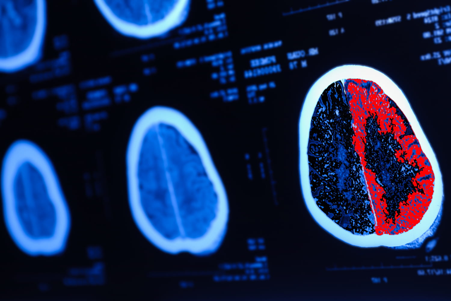 Des scientifiques découvrent un possible déclencheur de la maladie d'Alzheimer : il commence dès 50 ans