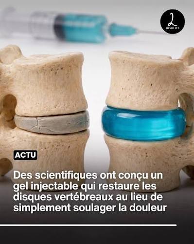 Des chercheurs ont développé un hydrogel injectable innovant capable d’aider à régénérer les disques vertébraux endommagés